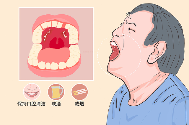 杭州御和堂中医讲解：为什么会得口腔癌？
